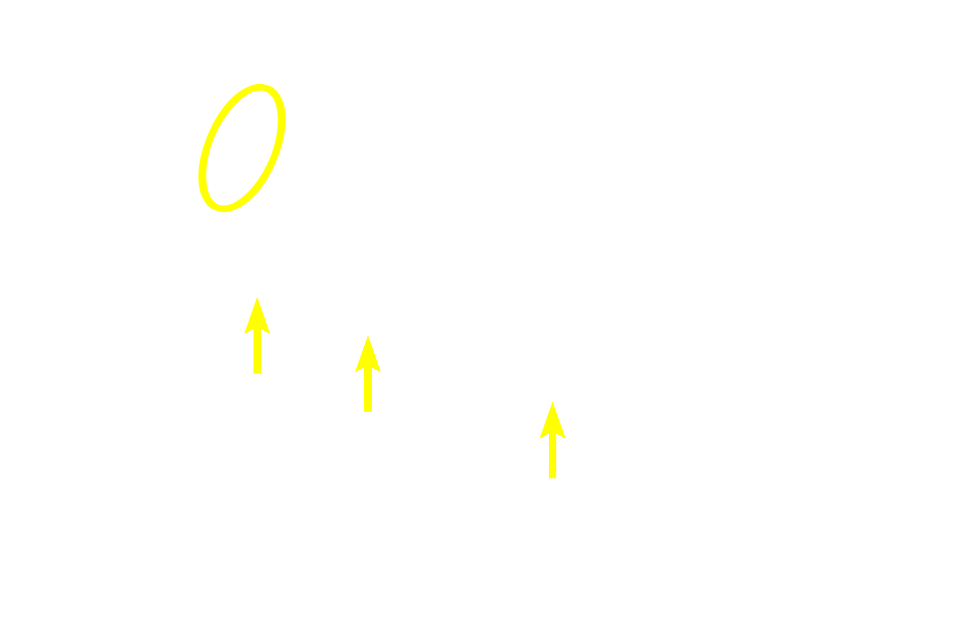  - Remnants of Rathke's pouch with colloid <p>This image shows a horizontal section through the human pituitary at the level indicated in the previous image.  The contrast between the pale-staining neural tissue and the deeply basophilic staining of the glandular adenohypophyseal tissue is evident.  The entire pituitary is surrounded by a dense connective tissue capsule that is continuous with the dura mater.  10x</p>
